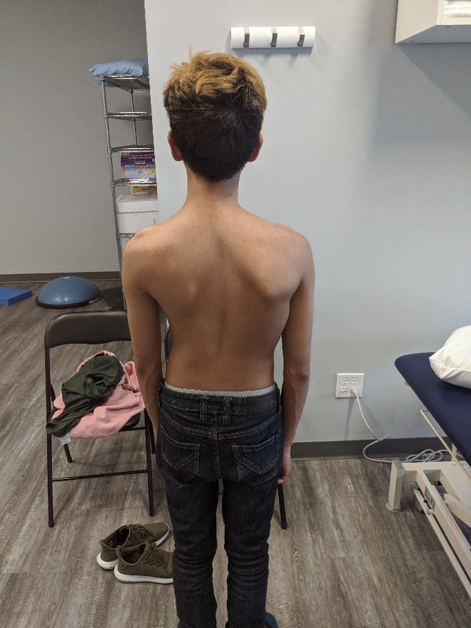 young boy with Scoliosis spine curve