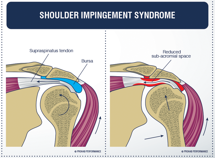 medical diagram to highlight shoulder pain