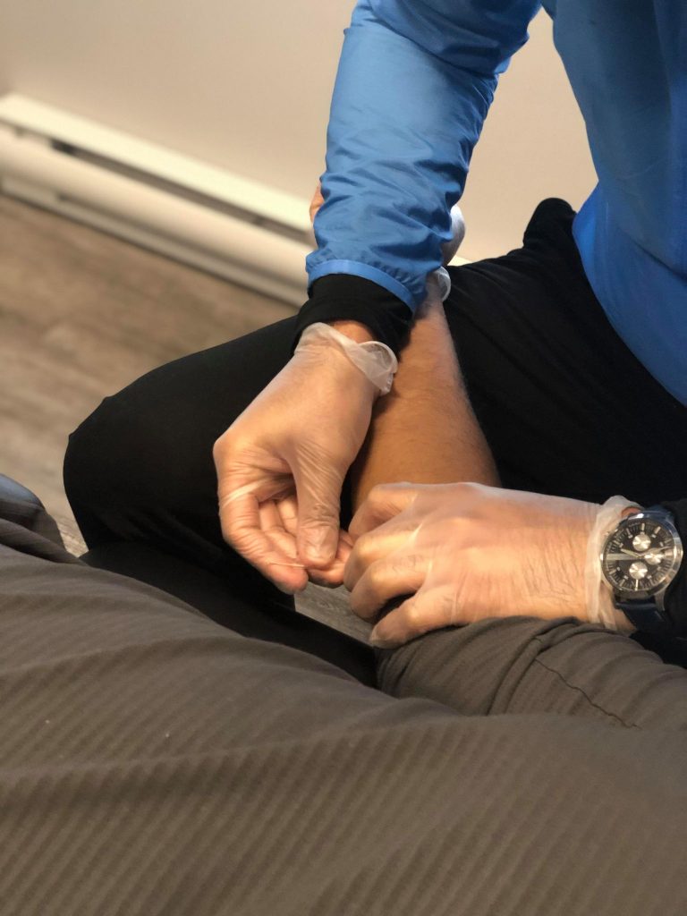 acupuncture needling being placed into an arm