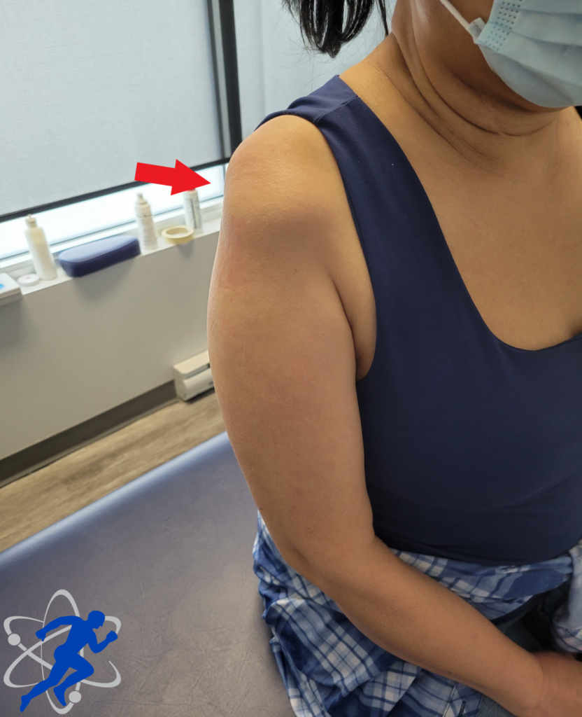 arrow pointing to rotator cuff on a woman patient.